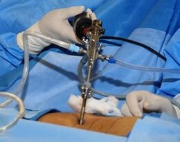 Chirurgesch Behandlung vu Lender Osteochendrosis