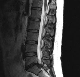 Diagnos Optiounen fir Lender OsteOchendrosis