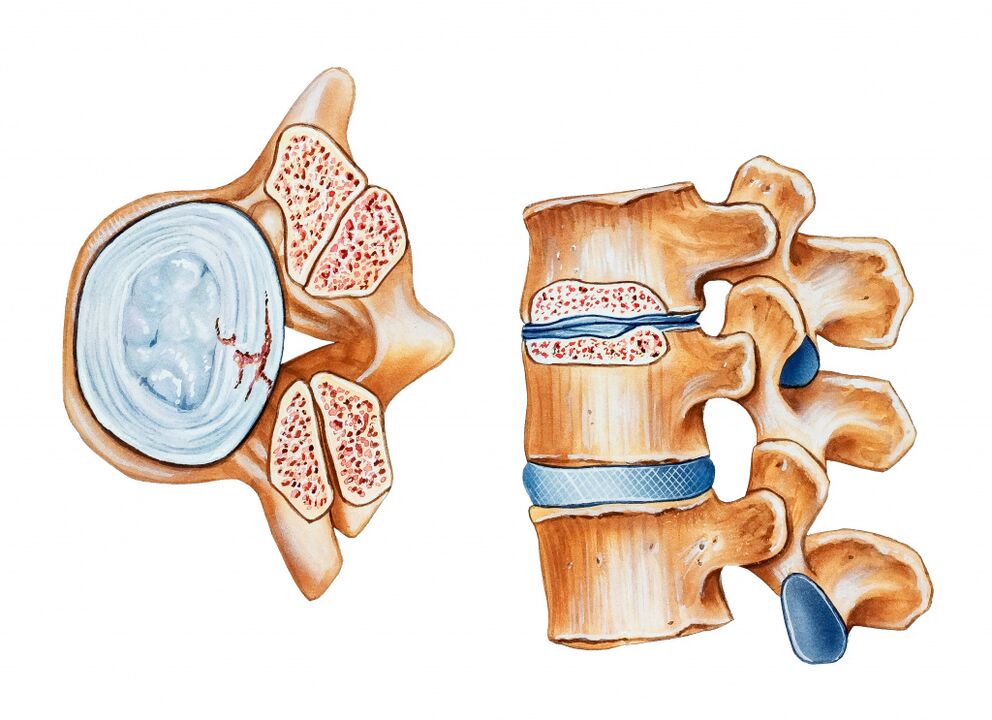 Osteochondrosis vun der Gebärmutterei féiert zur Zerstéierung vun der intervertirebraler Discs