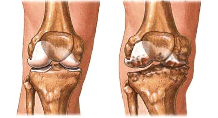 Gesond Gelenk an Arthrosis vum Knéi Gelenk