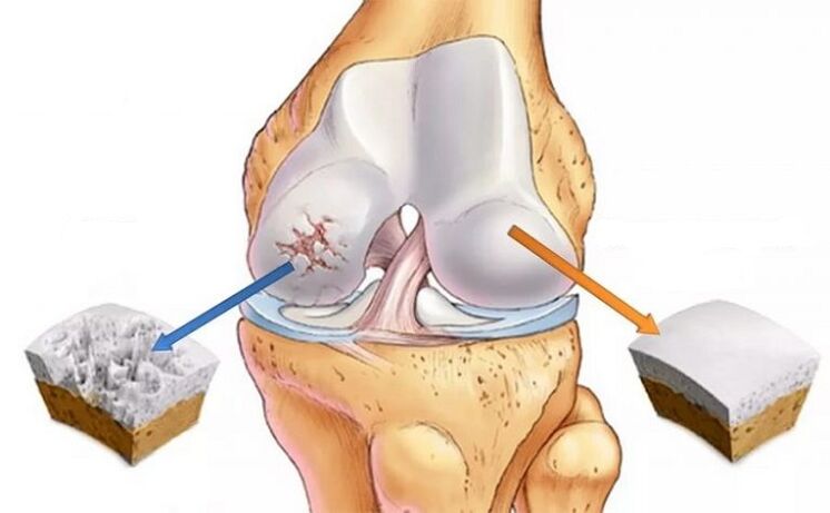 Gesonde Knorpel an Arthrosis vum Joint