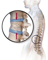 Osteoporosin provozéiert Réckschmerzen am ënneschten Réck