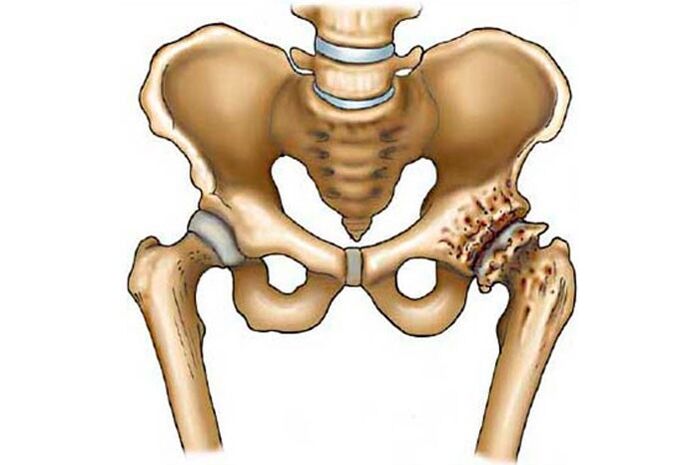 Arthrosis vum Hip Gelenk